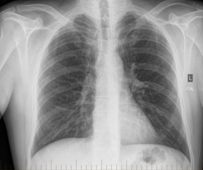 Image of a miner with coal workers' pneumoconiosis, classified as ILO 2/1. Image courtesy of Rhiannon McBean, PhD.