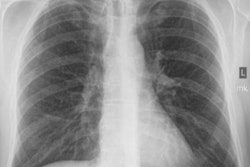 2020 02 18 17 27 1122 2020 02 20 Coal Dust X Ray 20200218174853