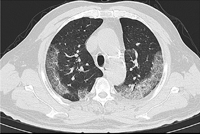 Axial chest CT image of a 74-year-old male with COVID-19 pneumonia showing bilateral subpleural ground-glass opacities. Image courtesy of the RSNA.