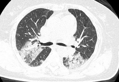 CT scan of a 79-year-old Chinese female with the novel coronavirus who died. Image courtesy of Dr. Yuxin Shi, PhD, from the Shanghai Public Health Clinical Center.
