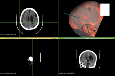 A color 3D reconstruction (top right) based on a patient's head CT scans, with an 'X' indicating the proposed site for SEPS placement. Image courtesy of Dr. Hansen Bow, PhD.