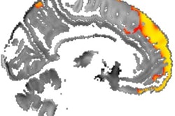 2020 02 21 22 35 4138 2020 02 24 3 D Mri Parkinsons 400