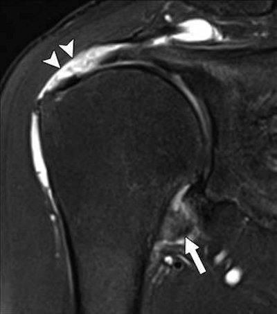 MR images are from a 67-year-old woman with shoulder pain and limited range of motion on external rotation, forward elevation, and internal rotation. Patient underwent rotator cuff repair with arthroscopic capsular release. Above: Oblique coronal fat-suppressed T2-weighted MR image shows thickening and edema in glenoid and humeral portions of joint capsule at axillary recess (arrow). Note full-thickness tear of supraspinatus tendon (arrowheads). Below: Oblique sagittal proton density MR image shows partial obliteration of subcoracoid fat triangle (arrow). Images courtesy of the AJR.