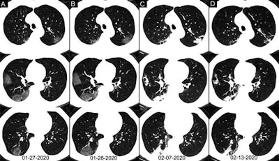 Axial chest CT images of a 62-year-old man with COVID-19 showing disease progression over time, from bilateral ground-glass opacities on January 27 (A) to multifocal organizing consolidation on February 13 (D). He had multiple negative results from RT-PCR tests, including those obtained on February 3 and 11. Image courtesy of the RSNA.