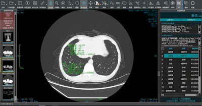 Ping An's algorithm can analyze medical images for signs of infection with COVID-19. Image courtesy of Ping An Insurance.
