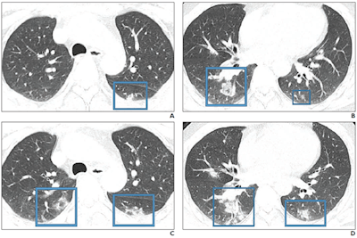 47-year-old Chinese man with two-day history of fever, chills, productive cough, sneezing, and fatigue who presented to emergency department. A and B: Initial CT images obtained show small round areas of mixed ground-glass opacity and consolidation (rectangles) at level of aortic arch (A) and ventricles (B) in right and left lower lobe posterior zones. C and D: Follow-up CT images obtained two days later show progression of abnormalities (rectangles) at the level of aortic arch (C) and ventricles (D), which now involve right upper and right and left lower lobe posterior zones. Images courtesy of the American Journal of Roentgenology.