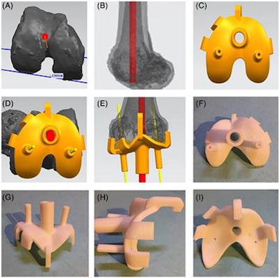 The workflow for creating patient-specific instrumentation using 3D CT data (A-E) and 3D printing technology (F-I). Image courtesy of He et al and licensed under CC BY-NC 4.0.