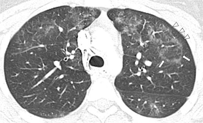 Contrast-enhanced chest CT image of a 16-year-old girl with EVALI showing central ground-glass opacity surrounded by a dense ring of consolidation (arrows) as well as subpleural spacing (arrowheads). Image courtesy of the RSNA.