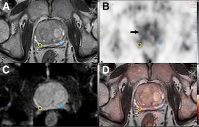 The images show coregistered axial 3D T2-weighted fast spin-echo MRI (A), choline-PET (B), apparent diffusion coefficient map (C), and PET/mpMRI (D). A small 0.16 cm3 right peripheral zone intermediate risk lesion (yellow circles) was confirmed as Gleason 4 + 4 cancer. Respective mirrored background volume of interest (blue circles) is shown, resulting in choline TBR of 1.61. Diffusely increased choline uptake is noted in benign prostate hyperplasia (arrow). Images courtesy of the Journal of Nuclear Medicine.