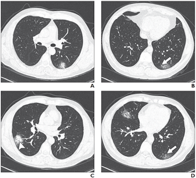Above: A 37-year-old man with confirmed COVID-19, common type. Patient had short-term exposure history to Wuhan and onset symptoms of fever (38° C) and cough. CT was performed on day of admission. A-D: CT images show bilateral multifocal ground-glass opacities (GGOs) and mixed GGOs and consolidation lesions. Traction bronchiectasis (arrowhead, C) and vascular enlargement (arrow, B and D) also are present. Below:A 63-year-old woman with confirmed COVID-19, severe type. Patient had long-term exposure history to Wuhan and onset symptoms of fever and cough. CT was performed one day after admission. A-D: CT images show bilateral diffuse GGOs and reticulation (arrow, C). All images courtesy of the AJR.