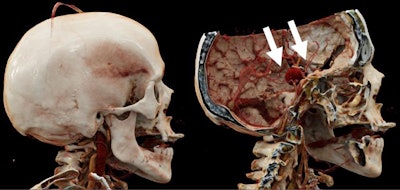 Cinematic rendering based on CT angiography scans of the head. 'Virtual craniotomy' allows for removal of the calvarium and 3D visualization of the giant, surgically excluded middle cerebral artery aneurysm (white arrows). Image courtesy of Dr. Travis Caton.