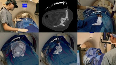 Intraoperative CT scans were projected as augmented reality holograms onto a patient undergoing cryotherapy for left iliac bone metastasis. Interventional radiologists registered the holograms to cryoablation probes on the patient and adjusted window settings in real-time to exclude soft tissue and focus on the bone.