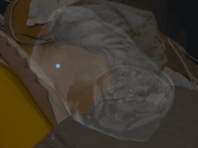 Augmented reality visualization based on MR images of a patient's metastatic neuroendocrine tumor. Interventional radiologists used augmented reality technology to plan their surgical approach for liver microwave ablation. Video and image courtesy of Dr. Brian Park.