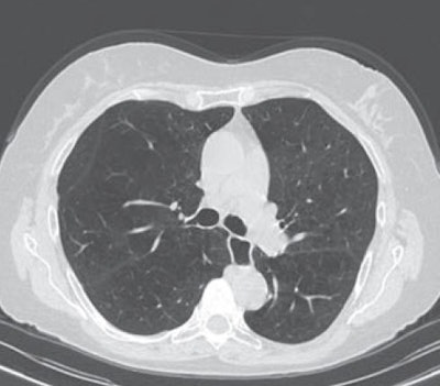 A 65-year-old man with severe lung emphysema (light blue on images below) seen on axial CT image (image 1 above), CT image including AI-based calculation (image 2), and 3D model (image 3). Extent of low-attenuation volume is seen inside green outline in both lungs in image 2. Purple outline in anterior right part of image 2 marks boundary between upper and middle lobes. Gray outline in image 2 correctly segments lower part of upper lobe and ensures that all lung tissue was considered. Also in image 2, orange outline denotes margin of tracheobronchial tree, and blue outline denotes margin of left lower lobe. All images courtesy of the AJR.