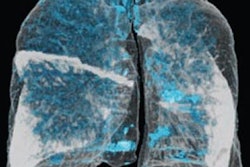 2020 03 06 22 45 5764 2020 03 09 Ai Emphysema3 20200306224409