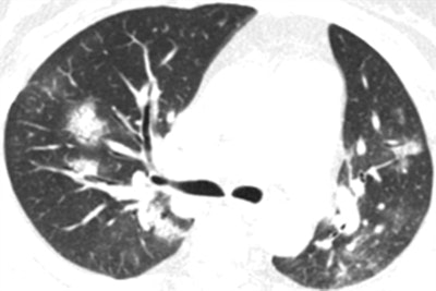 CT image of a 58-year-old woman with adenovirus infection showing ill-defined patchy ground-glass opacities and segmental and subpleural consolidations in both lungs, with most lesions along bronchovascular bundles. Image courtesy of the AJR.