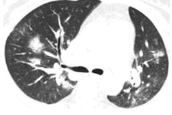 2020 03 09 23 31 5634 2020 03 10 Ct Adenovirus 400 20200309231011