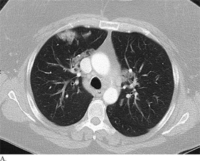 CT images of a patient with pneumonia misdiagnosed with COVID-19 (above) and a patient with COVID-19 misdiagnosed with non-COVID-19 pneumonia (below). All images courtesy of the RSNA.