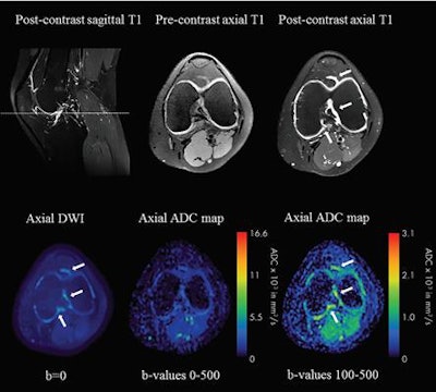 MR images are from a 17-year-old girl with polyarticular rheumatoid juvenile idiopathic arthritis and mild synovial inflammation. The score from the DWI dataset agreed with the reference standard that arthritis was present in this knee. Arrows indicate areas of synovial inflammation. ADC = apparent diffusion coefficient. Images courtesy of Radiology.