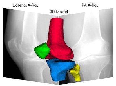 3D reconstruction of knee joint from x-ray images. Image courtesy of RSIP Vision.