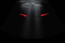 2020 03 16 22 09 9822 2020 03 19 Covid 19 Ultrasound Ct 1 20200316222352