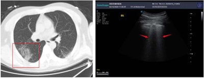 Above: A CT scan and ultrasound scan from one patient with COVID-19. Below: A CT scan and ultrasound scan from a second patient with COVID-19. All images published in SSRN and courtesy of Yi Huang and colleagues.