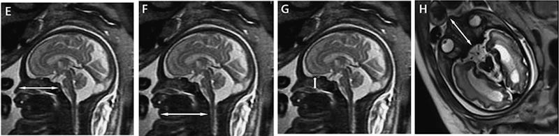 MRI helps create measures for normal fetal development | AuntMinnie