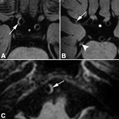 MR images were acquired of a 69-year-old man with left-sided ischemic stroke 56 days after symptom onset. His cardiovascular risk factors were hypertension and diabetes mellitus. The Second Manifestations of Arterial Disease vascular risk score was 37%, indicating a 37% chance of a recurrent vascular event within 10 years. Fourteen vessel wall lesions were detected on pre- and postcontrast 7-tesla transverse 3D T1-weighted MRI. In the anterior circulation, postcontrast images (A, B) show vessel wall thickening (arrow in A) of the supraclinoid portion of the right internal carotid artery and right M1 segment (arrow in B). In the posterior circulation, postcontrast images (B, C) show vessel wall lesions in right P2 segment (arrowhead in B) and basilar artery (arrow in C). Images courtesy of Radiology.