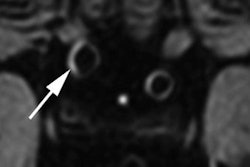 2020 03 18 23 26 7770 2020 03 19 7 T Mri Stroke 20200318232529