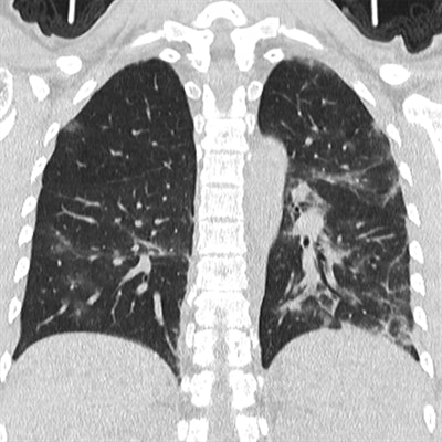 CT images of a 29-year-old pregnant woman with mild pneumonia from COVID-19. Images obtained during peak disease stage show multiple ground-glass opacities with bilateral partial consolidation (above) and during the final absorption stage six days later (below). Images courtesy of the American Journal of Roentgenology (AJR).