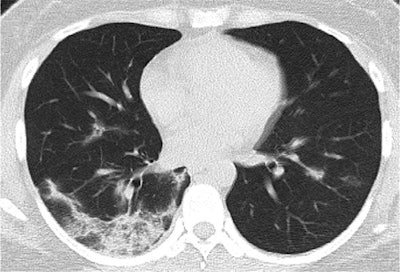 CT image from an exam performed on day 15 of illness in a 35-year-old woman with COVID-19. The image shows ground-glass opacity with a mixed pattern, and perilobular consolidation suggests possible organizing pneumonia. The patient was discharged two days later. Image courtesy of the RSNA.