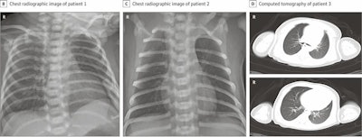 Images of newborns with COVID-19 showing pneumonia on chest x‑ray (left, center) and CT (right). All images courtesy of JAMA Network.