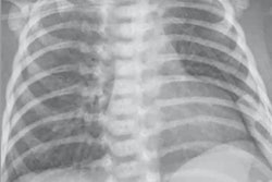2020 03 26 19 50 2267 2020 03 26 X Ray Covid 19 Newborn