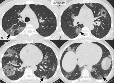 Images of a 52-year-old man confirmed to have COVID-19 showing typical CT features, including bilateral, multifocal rounded ground-glass opacity (asterisks) and peripheral ground-glass opacity (arrows) with superimposed interlobular septal thickening and crazy-paving pattern (i.e., visible intralobular lines). Image courtesy of the RSNA.