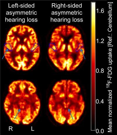 Axial FDG-PET images at level of primary auditory cortex (top, volume-of-interest outline in blue) and inferior colliculus (bottom) in two representative patients with left-sided (left image) and right-sided (right image) asymmetrical hearing loss. Arrows indicate side of decreased metabolism. Images courtesy of Journal of Nuclear Medicine.