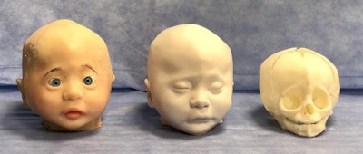 3D-printed models based on head CT scans of a patient with metopic craniosynostosis. Image courtesy of Dr. Giselle Coelho.