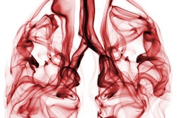 2017 02 01 16 41 06 305 Lungs Smoke 400