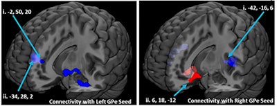MR brain images show the effects of drinking in the past 30 days, with excessive alcohol changing connectivity in basil ganglia region. Increases in connectivity from intoxication are indicated in red, while connectivity decreases are in blue. Images courtesy of PLOS One.