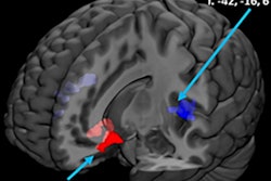 2020 03 30 17 20 2190 F Mri Alcohol Induced Connectivity Changes Fede Thumb