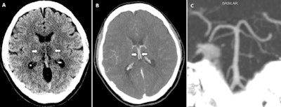 A, Image from noncontrast head CT demonstrates symmetric hypoattenuation within the bilateral medial thalami (arrows). B, Axial CT venogram demonstrates patency of the cerebral venous vasculature, including the internal cerebral veins (arrows). C, Coronal reformat of a CT angiogram demonstrates normal appearance of the basilar artery and proximal posterior cerebral arteries. All images courtesy of the RSNA.