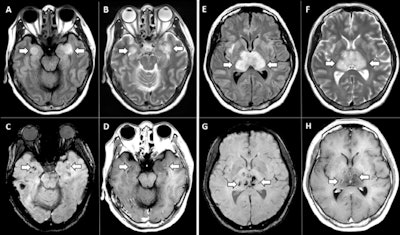 MRI images demonstrate T2 FLAIR hyperintensity within the bilateral medial temporal lobes and thalami (A, B, E, F) with evidence of hemorrhage indicated by hypointense signal intensity on susceptibility-weighted images (C, G) and rim enhancement on postcontrast images (D, H).