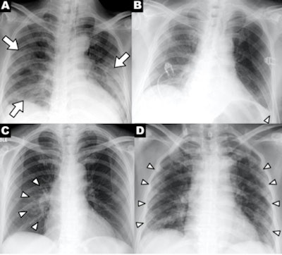 A series of chest x-ray findings of a patient with COVID-19 demonstrating clinical characteristics of disease: (A) patchy consolidations, (B) pleural effusion, (C) perihilar distribution, and (D) peripheral distribution. Images courtesy of RSNA.