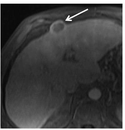 MR image is from a 60-year-old woman with 2.7-cm macrotrabecular-massive hepatocellular carcinoma (HCC) (arrow). Transverse multiphase MRI scans show the macrotrabecular-massive HCC as a hyperintense central area on T2-weighted image, corresponding to substantial necrosis. Image courtesy of Radiology.