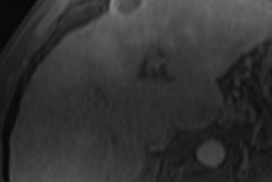 2020 04 02 21 33 6699 2020 04 02 Mri Hcc Necrosis Rad 400