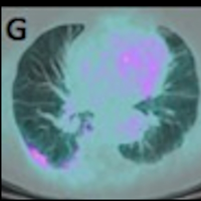 2020 04 02 22 01 2165 2020 04 02)covid 19 Fdg Pet Ct Jnm Albano Image G 400