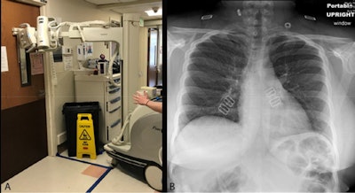 Chest radiography through glass. Technologists position the portable x-ray unit outside the patient room, with the tube peering through the wire-reinforced isolation room window (A). The anteroposterior chest x-ray obtained is of diagnostic quality (B). Images courtesy of the RSNA.