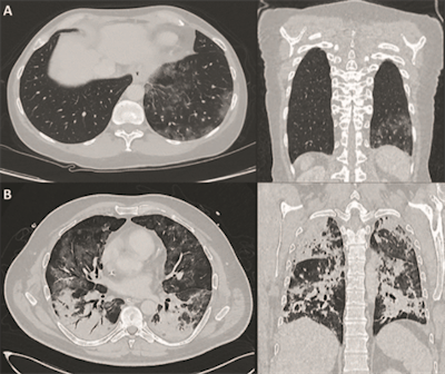 CT images of two patients with COVID-19 pulmonary manifestations. Incidental finding of SARS-CoV-2 infection in an asymptomatic 60-year old female (A) show peripheral ground-glass opacities in basal segments of the right lung. A polymerase chain reaction test confirmed SARS-CoV-2 infection on molecular level. A 51-year-old SARS-CoV-2-positive male (B) with pronounced bilateral pulmonary involvement of COVID-19 was hospitalized in an intensive care unit. Typical lesion spread to the center of the lungs and consolidation is present. Images courtesy of Nuklearmedizin.