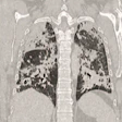 2020 04 09 22 22 3244 Covid Fdg Pet Ct Images Leutje 400