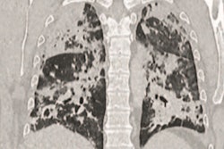 2020 04 09 22 22 3244 Covid Fdg Pet Ct Images Leutje 400