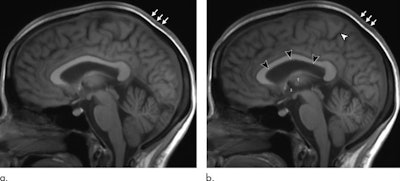 Reconstructed 5-mm orthogonal midline MR brain images using the sagittal 3D T1-weighted dataset show preflight baseline image (a) and matching postflight image (b) one day after return in the same astronaut. Black arrowheads show upward expansion of the anterior, middle, and posterior superior margins of the lateral ventricle with associated narrowing of the marginal sulcus of the cingulate sulcus (white arrowhead). There also is subtle expansion of the third ventricle (indicated by a 3, middle of left image), which has displaced the thalamus (T, left image) from midline, making it less visible. There is thickening of the intermediate signal scalp soft tissues (arrows). Images courtesy of Radiology.